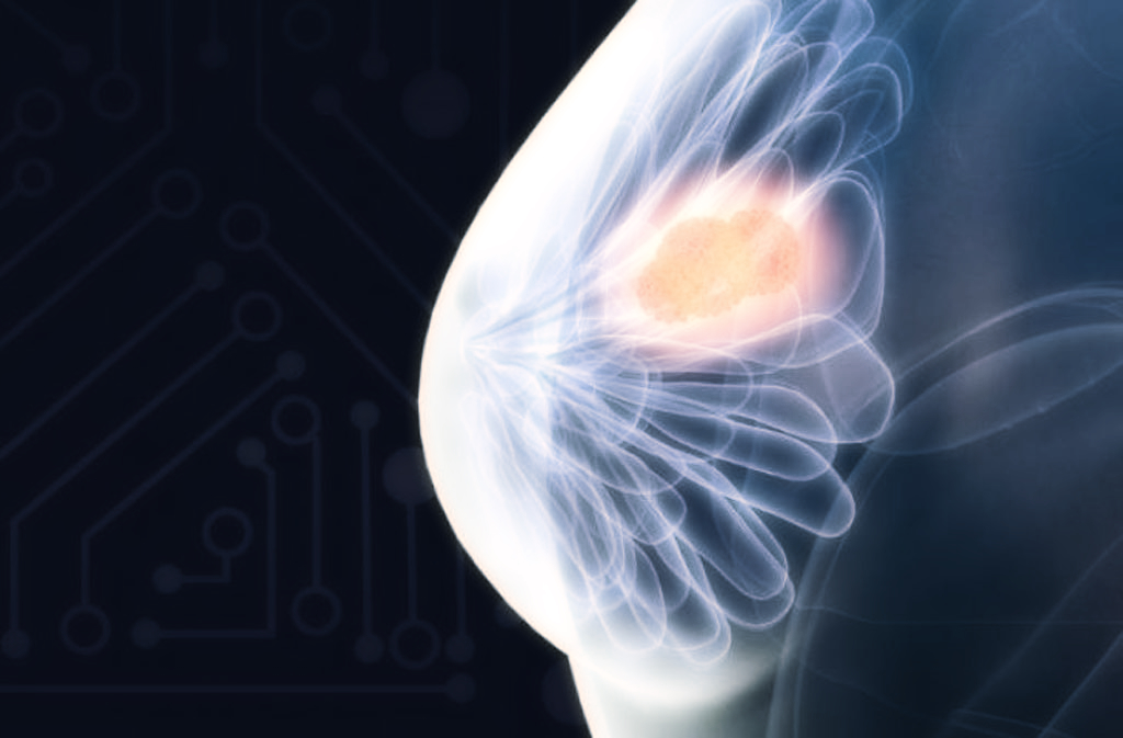 الذكاء الاصطناعي يتمكن من الكشف عن سرطان الثدي مبكراً