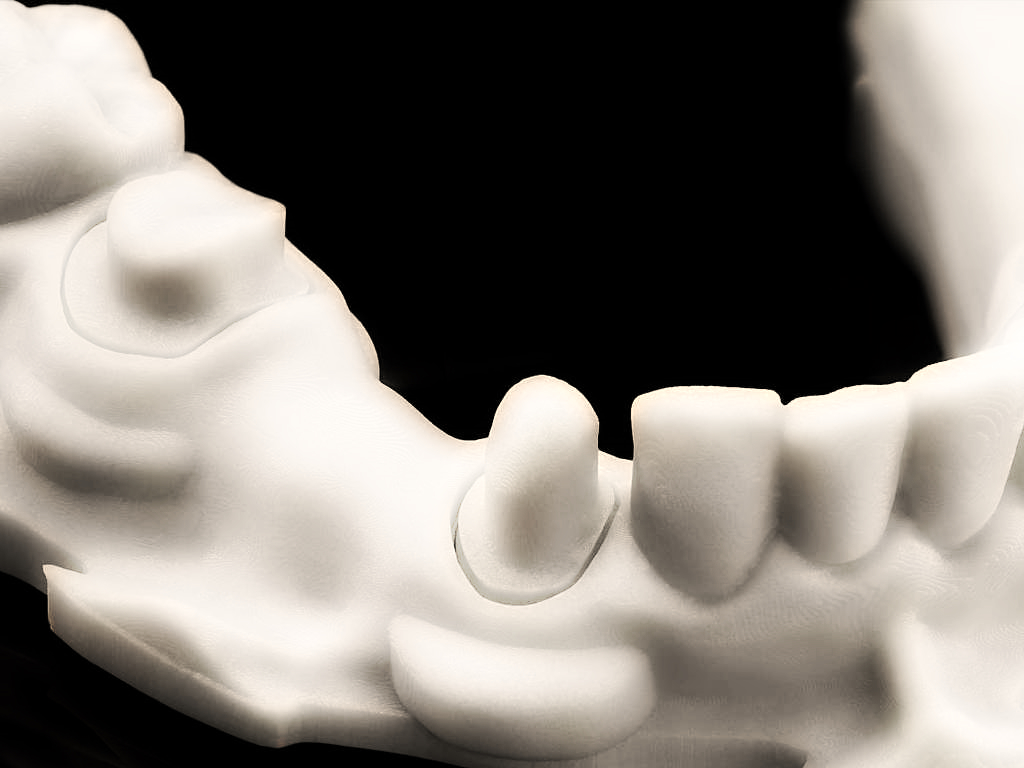 أسنان مقاومة للجراثيم بتقنية الطباعة